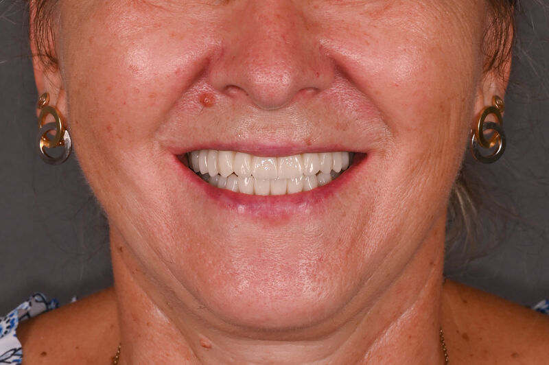 Zâmbet lateral stanga_dupa